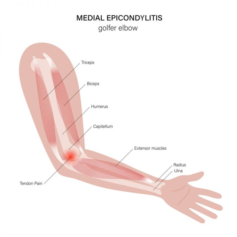 common golf injuries